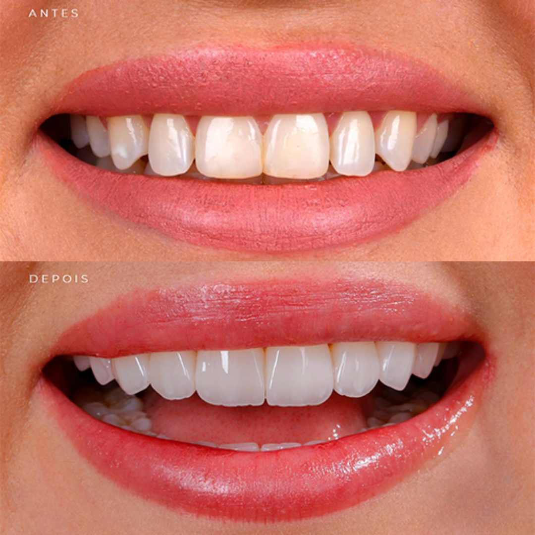 Antes e depois de clareamento dental profissional em Goiânia