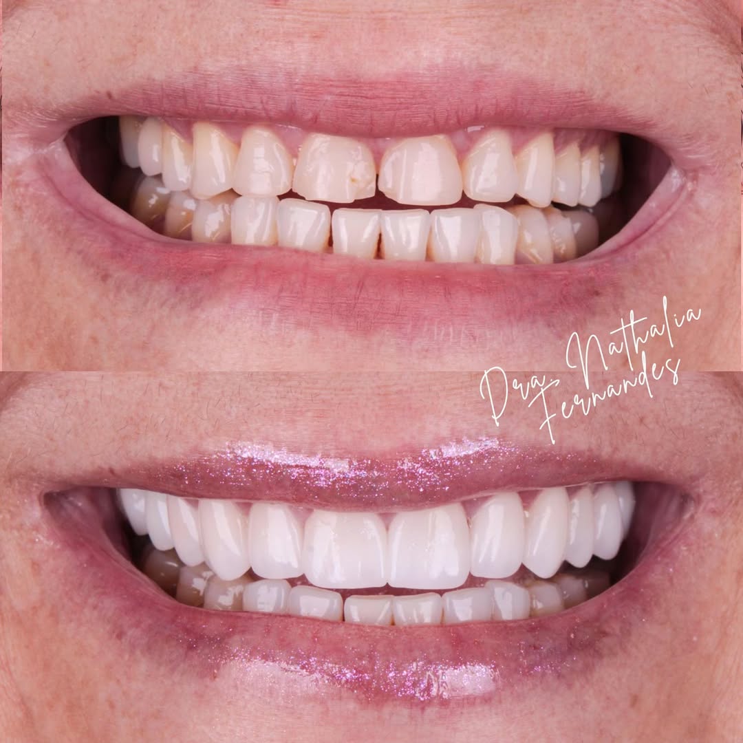 Antes e depois de facetas de porcelana (lentes de contato dental) realizadas em Goiânia