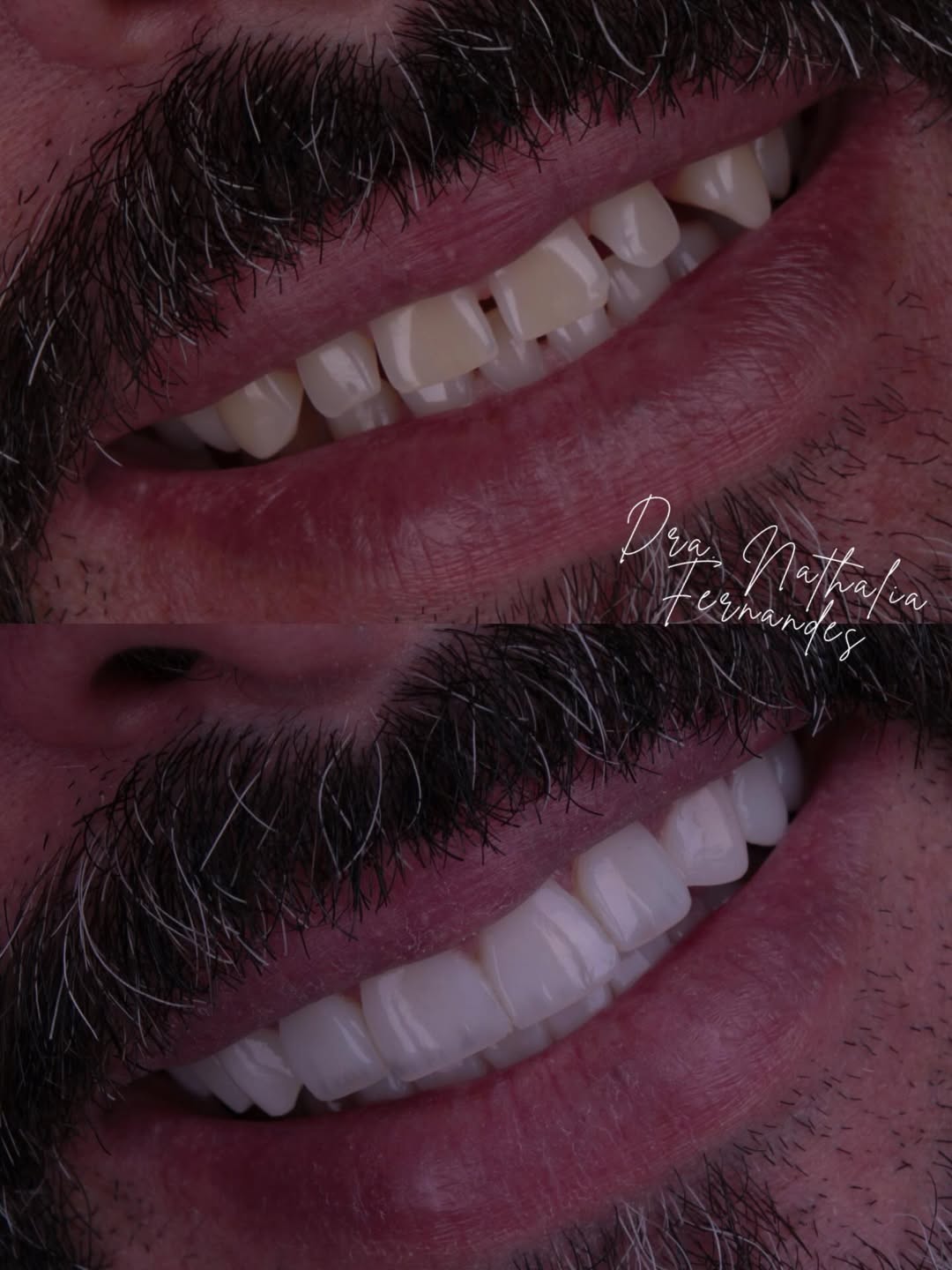Antes e depois de facetas de resina corrigindo desgaste dental em Aparecida de Goiânia