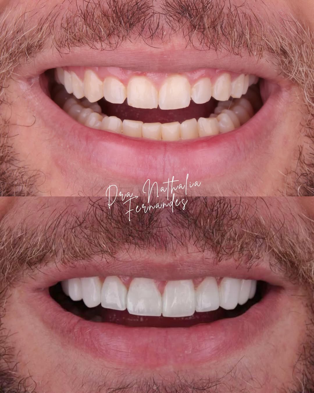 Antes e depois de facetas de resina entregando sorriso harmônico em paciente de Trindade
