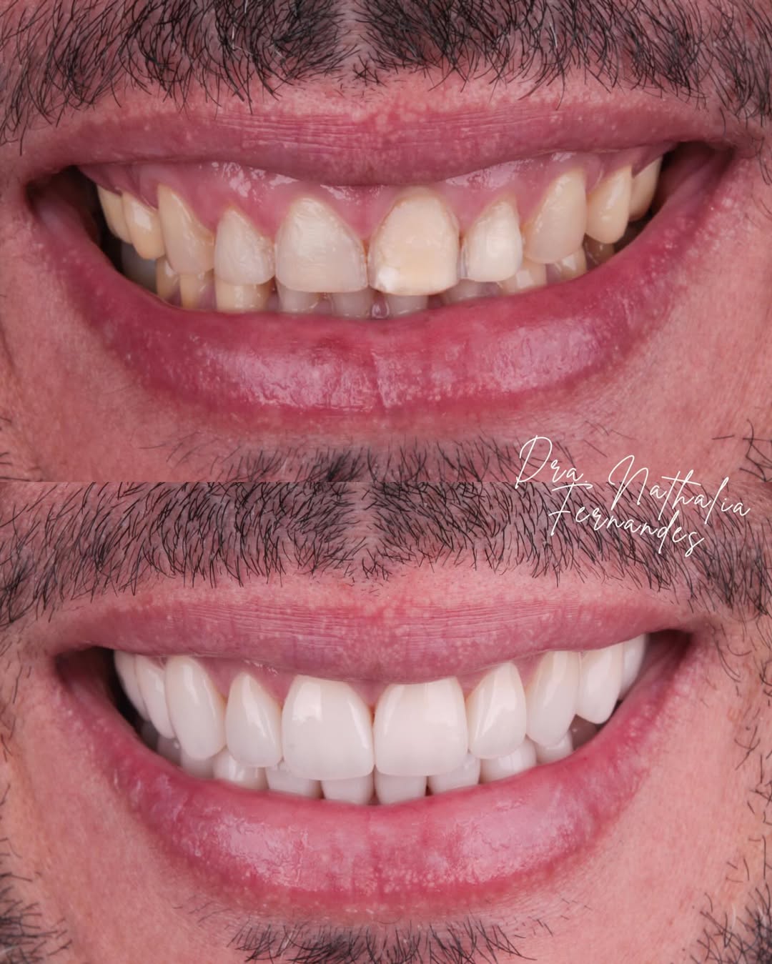 Antes e depois de facetas de resina com mudança completa de cor e formato em Goiânia